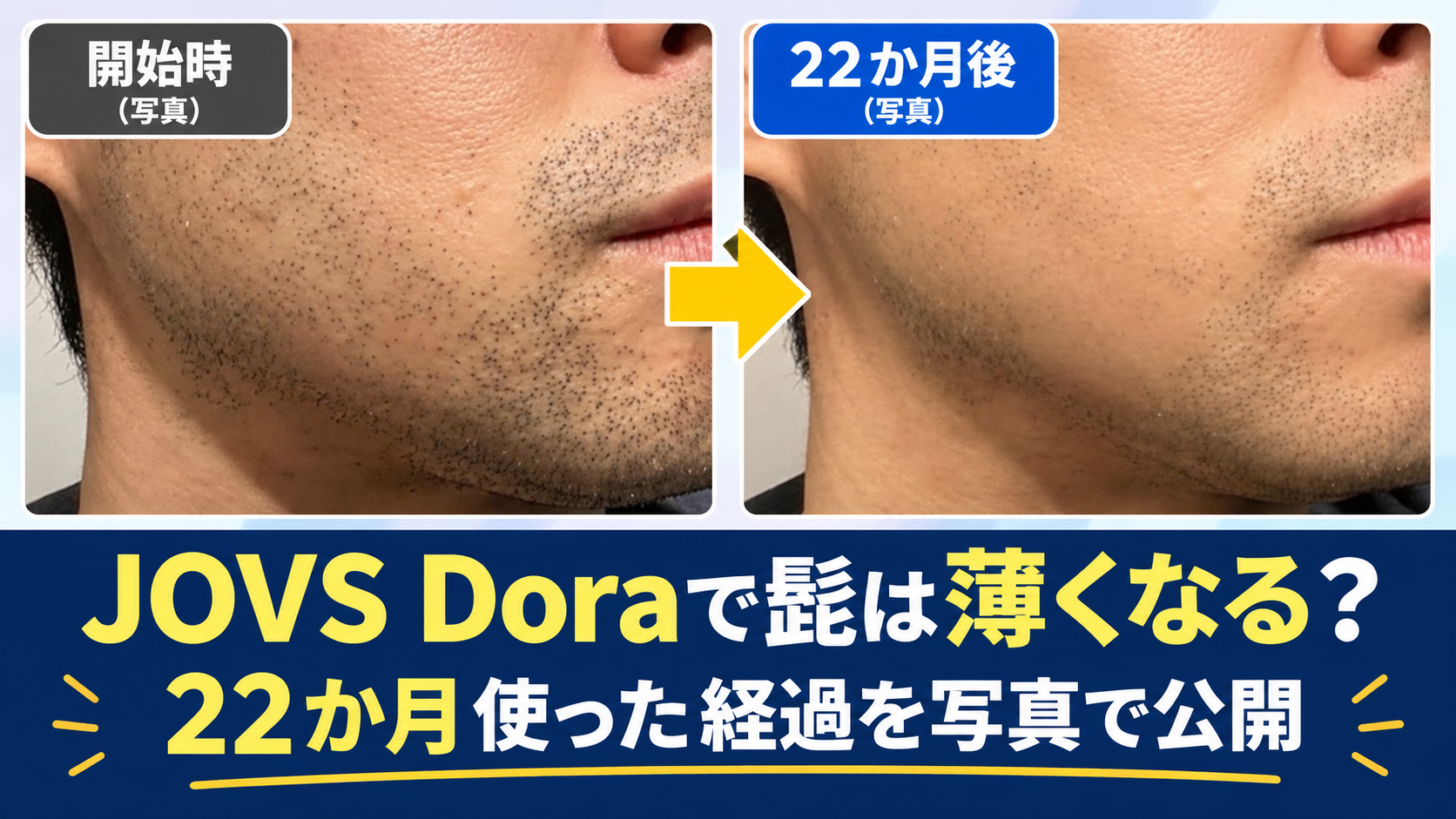 JOVS Doraで髭は薄くなる?22か月使った経過を写真で公開